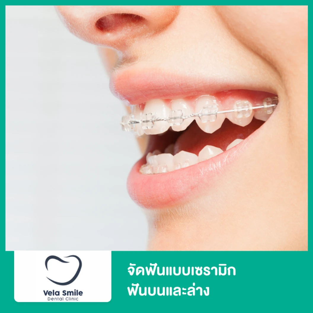 จัดฟันแบบเซรามิก ฟันบนและล่าง