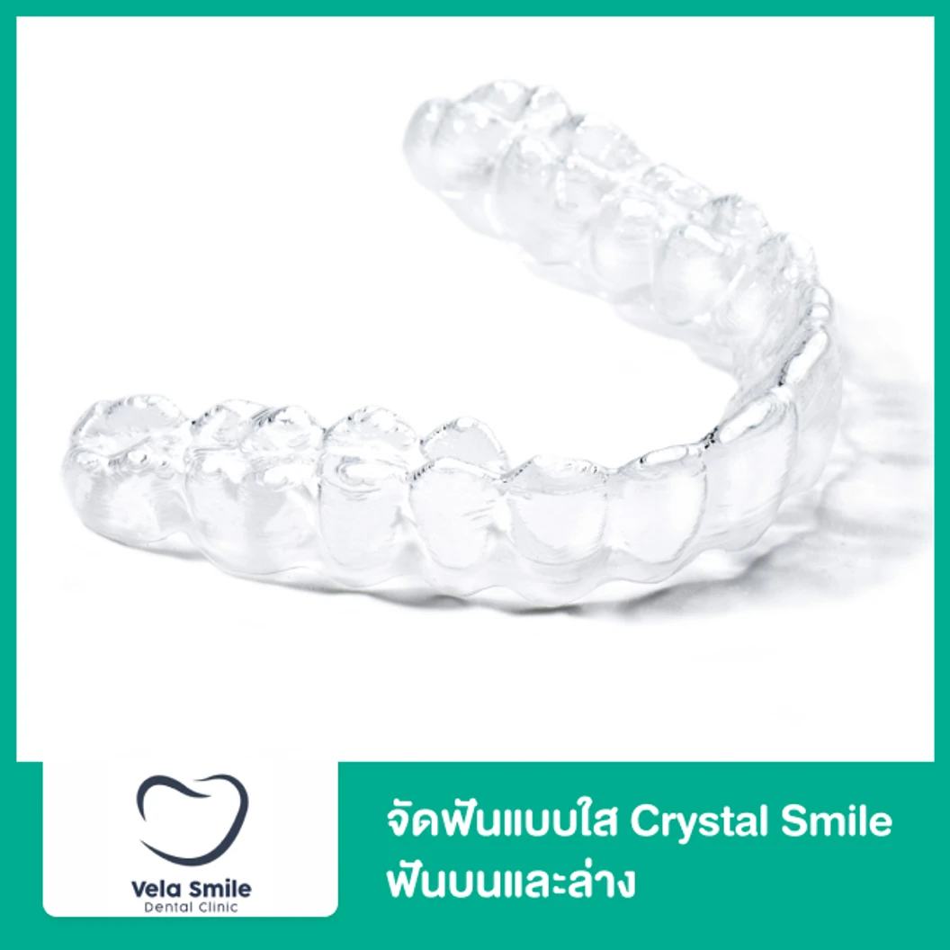 จัดฟันแบบใส Crystal Smile Moderate ฟันบนและล่าง