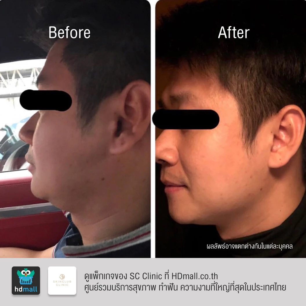 โปรแกรมโบท็อกซ์ 100 ยูนิต (หน้า)