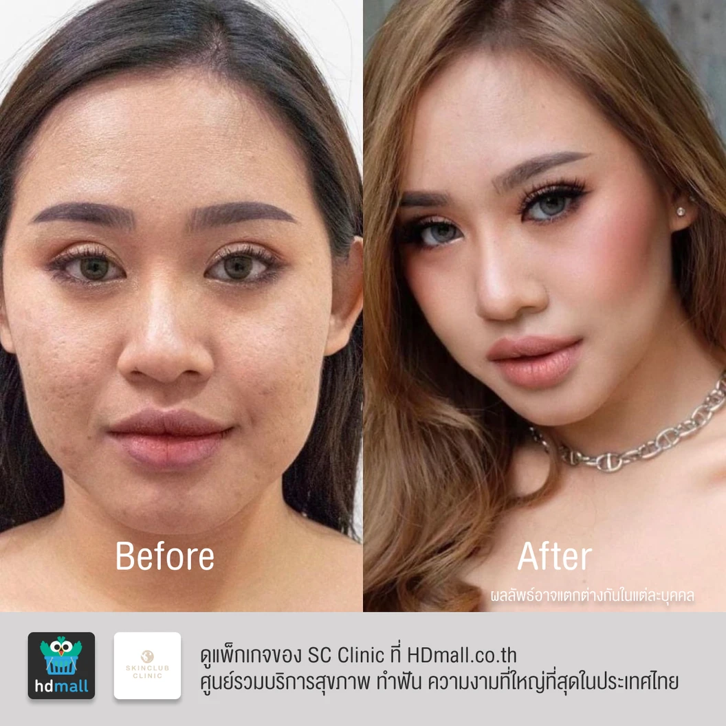 โปรแกรมโบท็อกซ์ 100 ยูนิต (หน้า)