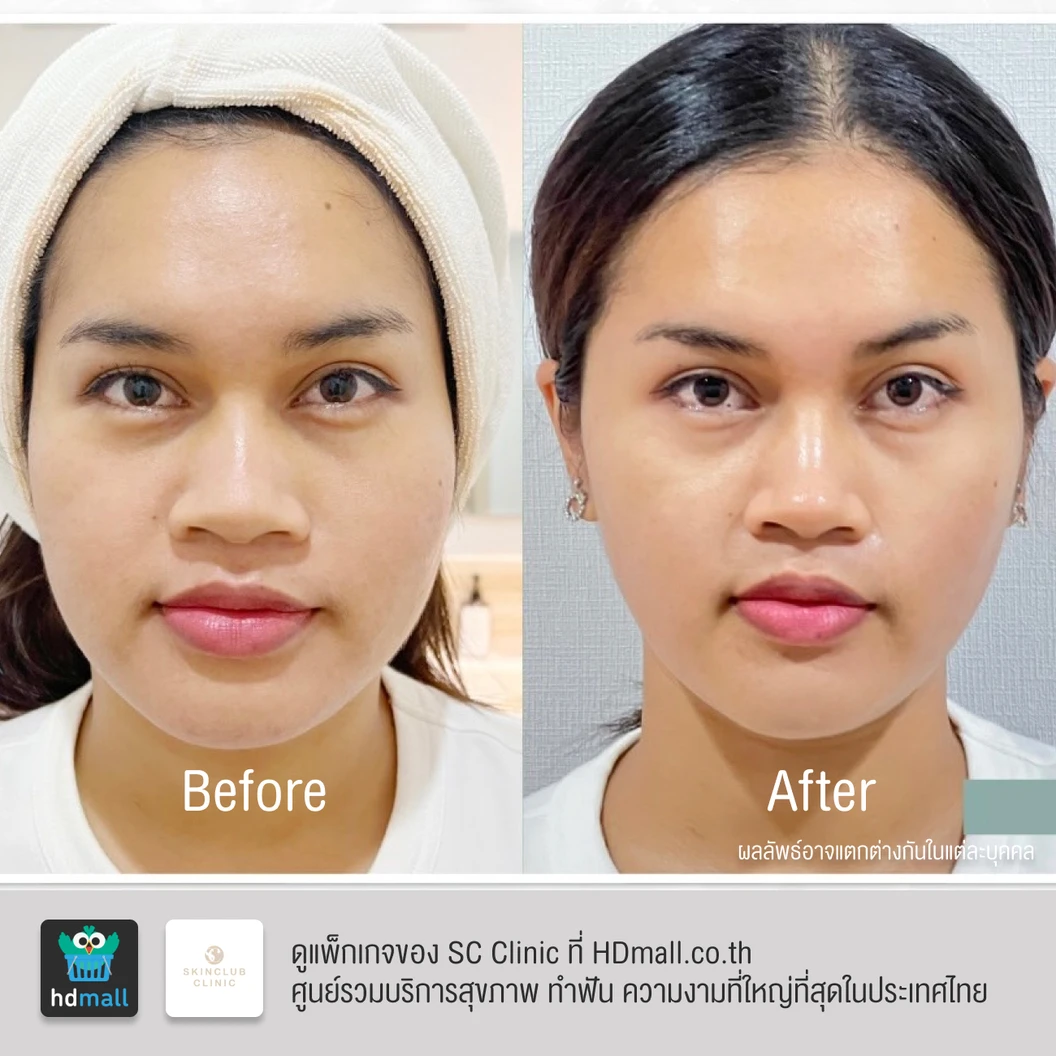 โปรแกรมโบท็อกซ์ 100 ยูนิต (หน้า)