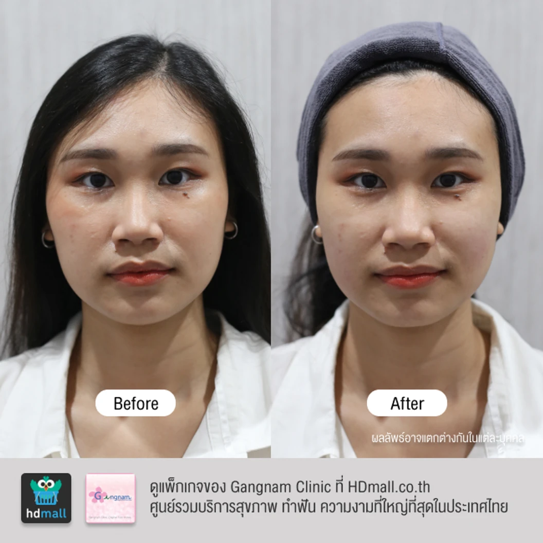 ทำ HIFU เครื่อง Ultra V HIFU Plus ไม่จำกัดช็อต บริเวณแก้มและร่องแก้ม 1 ครั้ง