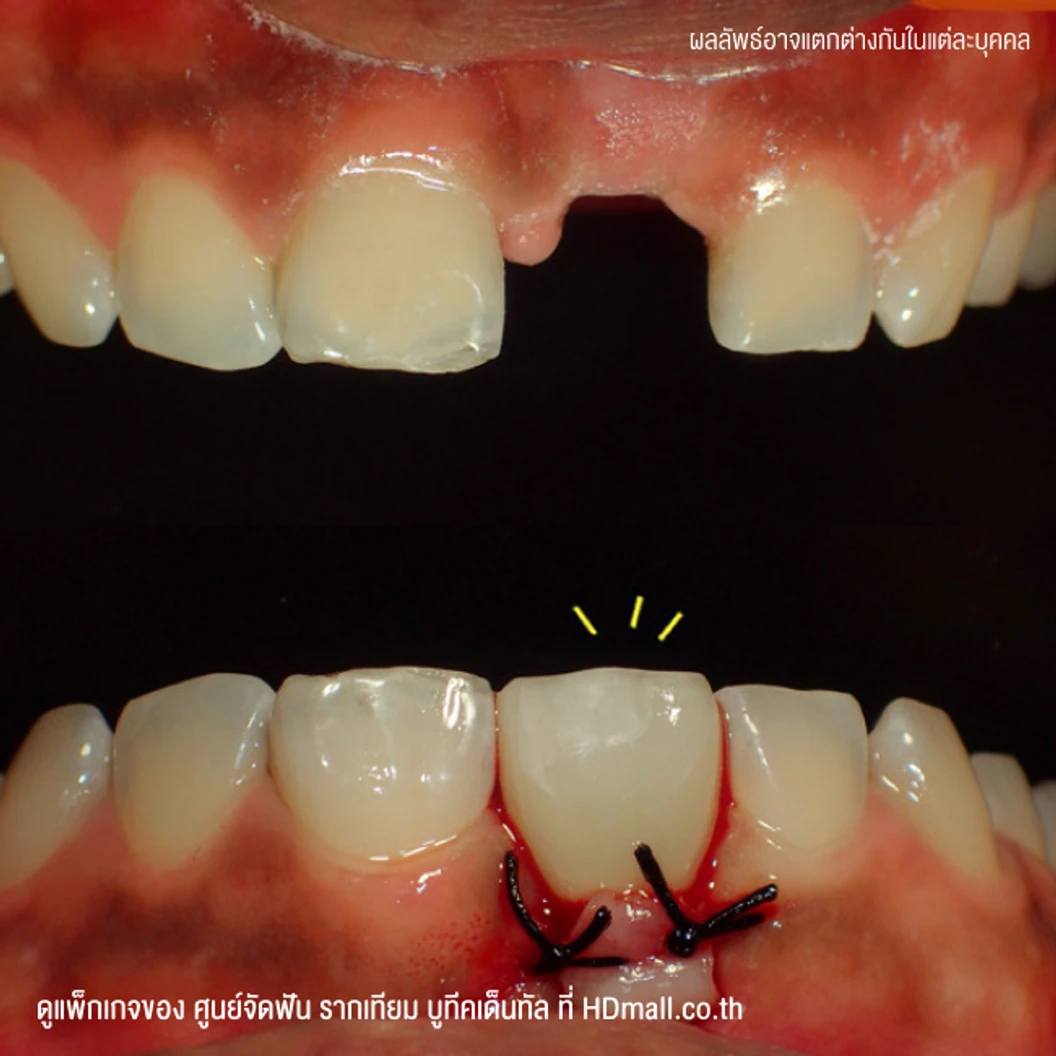 ทำรากฟันเทียม ยี่ห้อ Dentium รวมครอบฟัน PFM 1 ซี่