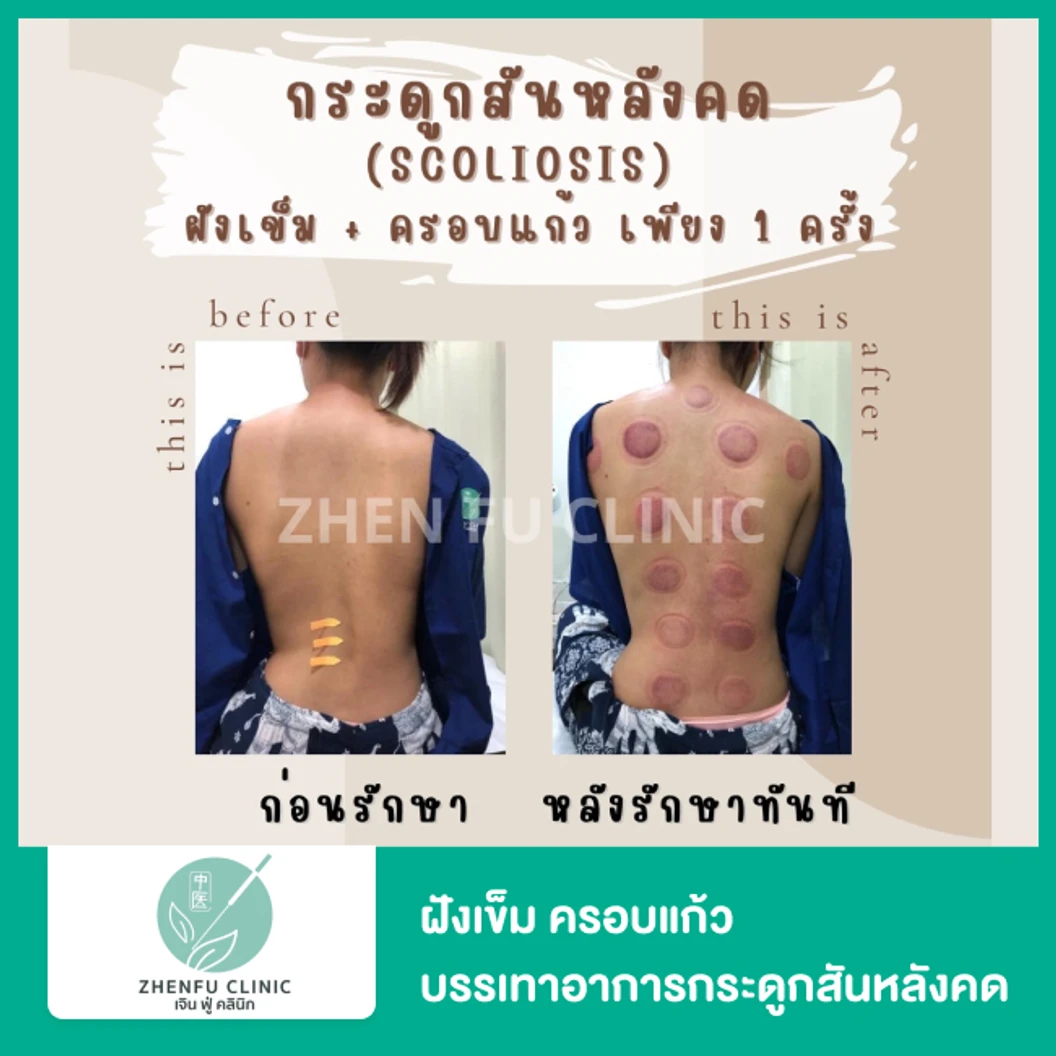 ฝังเข็ม ครอบแก้ว บรรเทาอาการกระดูกสันหลังคด 1 ครั้ง