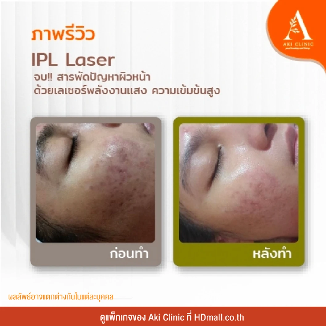 ทำ IPL บริเวณใบหน้า แก้ปัญหารอยดำ รอยแดง รอยสิว ปรับผิวสม่ำเสมอ 1 ครั้ง