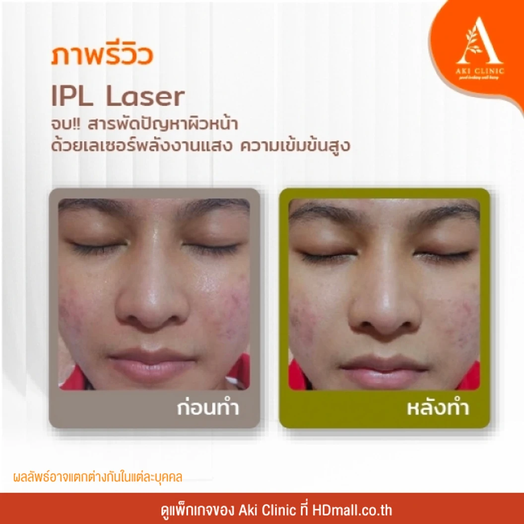ทำ IPL บริเวณใบหน้า แก้ปัญหารอยดำ รอยแดง รอยสิว ปรับผิวสม่ำเสมอ 1 ครั้ง