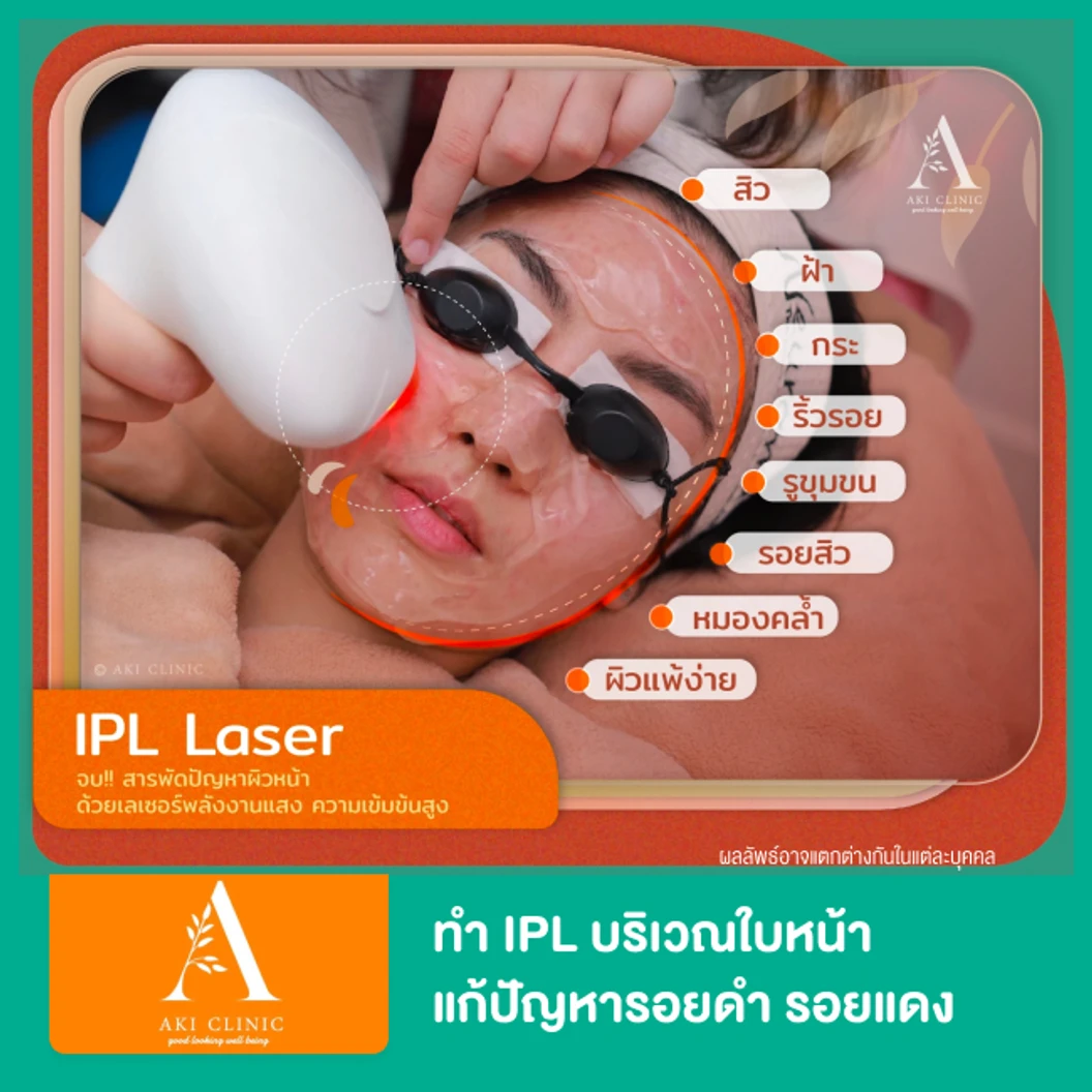 ทำ IPL บริเวณใบหน้า แก้ปัญหารอยดำ รอยแดง รอยสิว ปรับผิวสม่ำเสมอ 1 ครั้ง