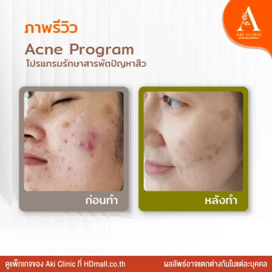 Acne Program โปรแกรมรักษาสิว 2 ขั้นตอน 1 ครั้ง