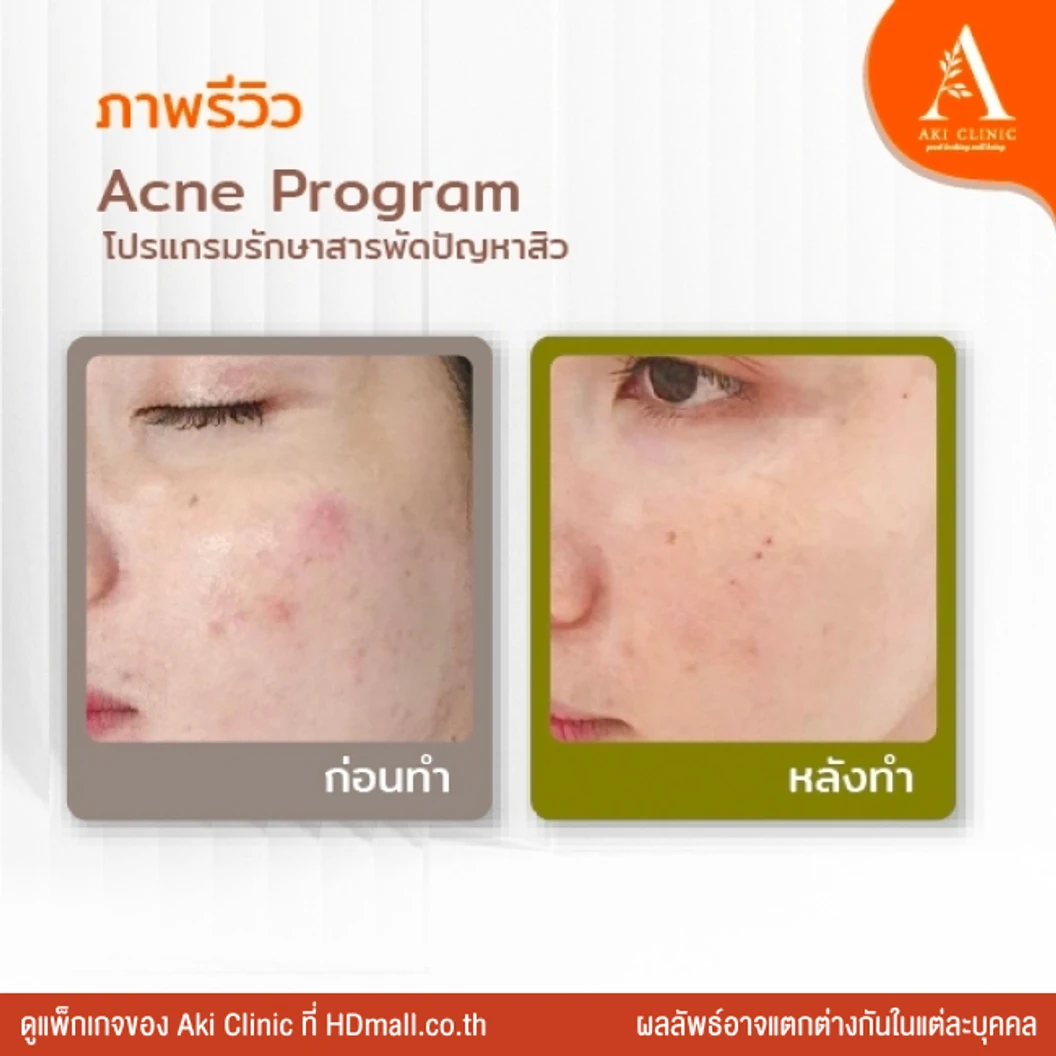 Acne Program โปรแกรมรักษาสิว 2 ขั้นตอน 1 ครั้ง