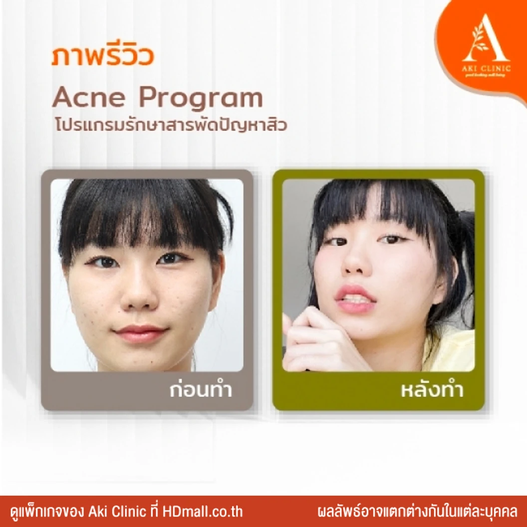 Acne Program โปรแกรมรักษาสิว 2 ขั้นตอน 1 ครั้ง
