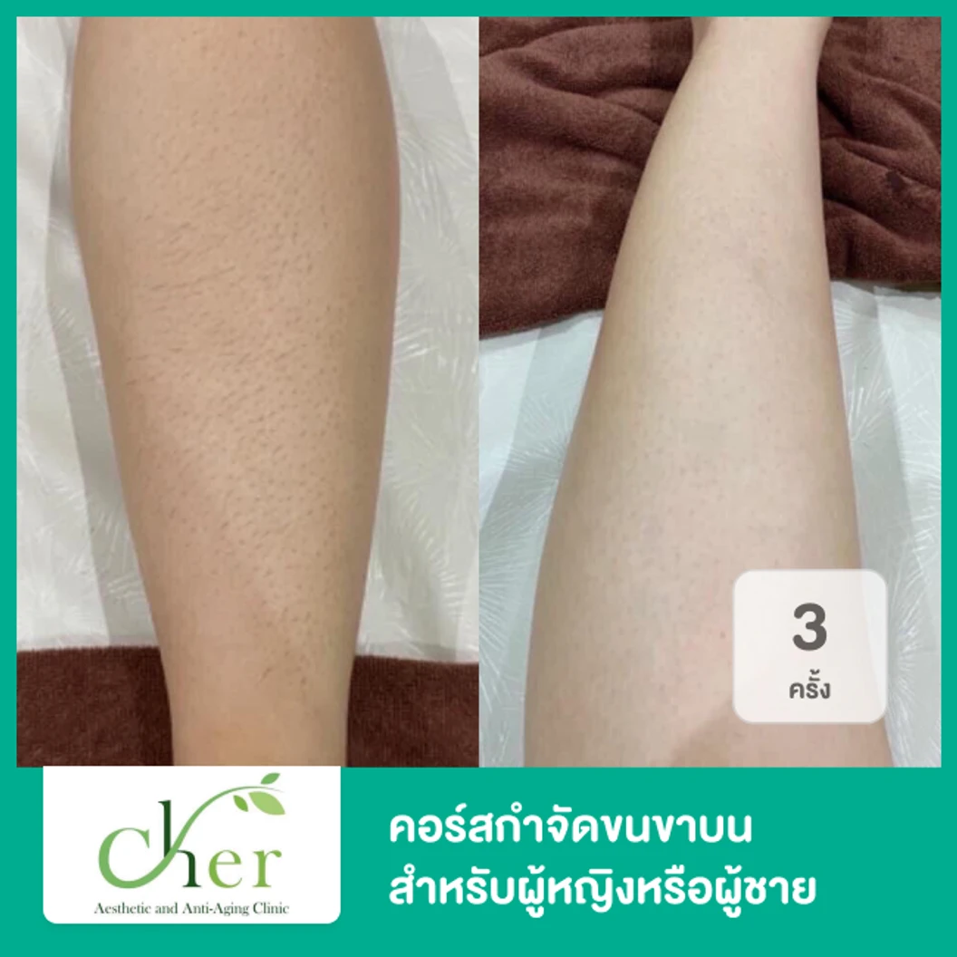 คอร์สกำจัดขนขาบน ด้วย Diode Laser 3 ครั้ง ภายใน 3 เดือน สำหรับผู้หญิงหรือผู้ชาย