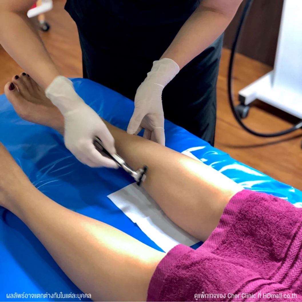 คอร์สกำจัดขนขาท่อนล่าง ด้วย Diode Laser 12 ครั้ง ภายใน 1 ปี สำหรับผู้หญิงหรือผู้ชาย