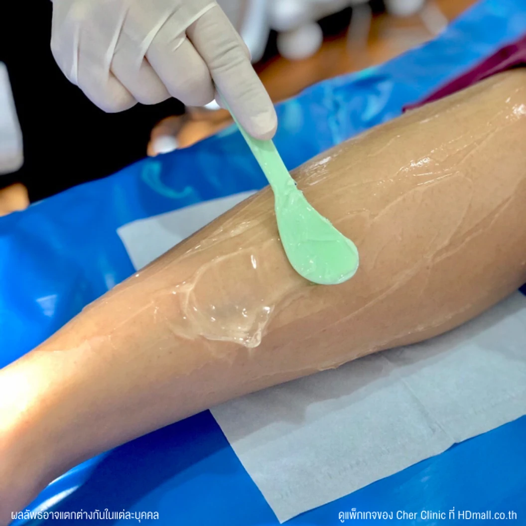 คอร์สกำจัดขนขาท่อนล่าง ด้วย Diode Laser 12 ครั้ง ภายใน 1 ปี สำหรับผู้หญิงหรือผู้ชาย