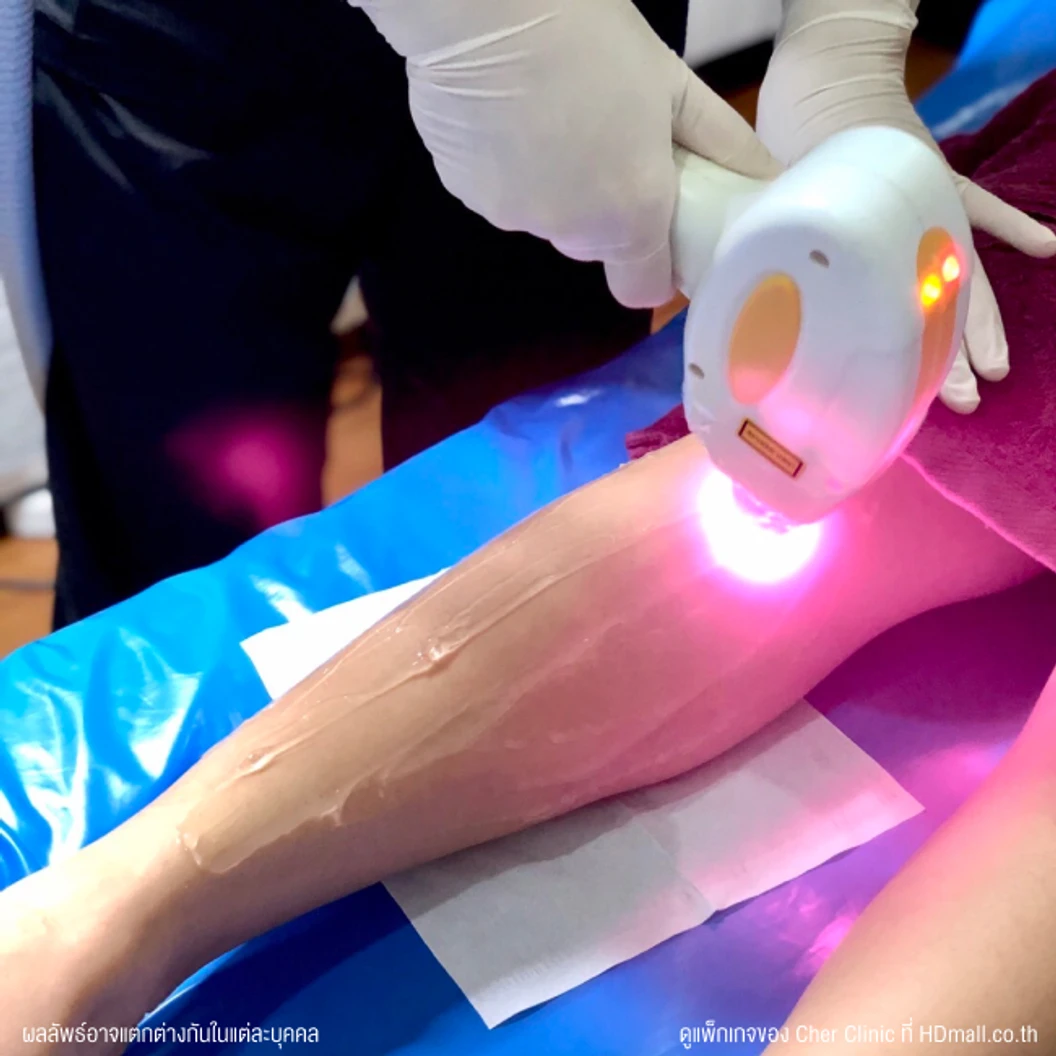 คอร์สกำจัดขนขาท่อนล่าง ด้วย Diode Laser 12 ครั้ง ภายใน 1 ปี สำหรับผู้หญิงหรือผู้ชาย