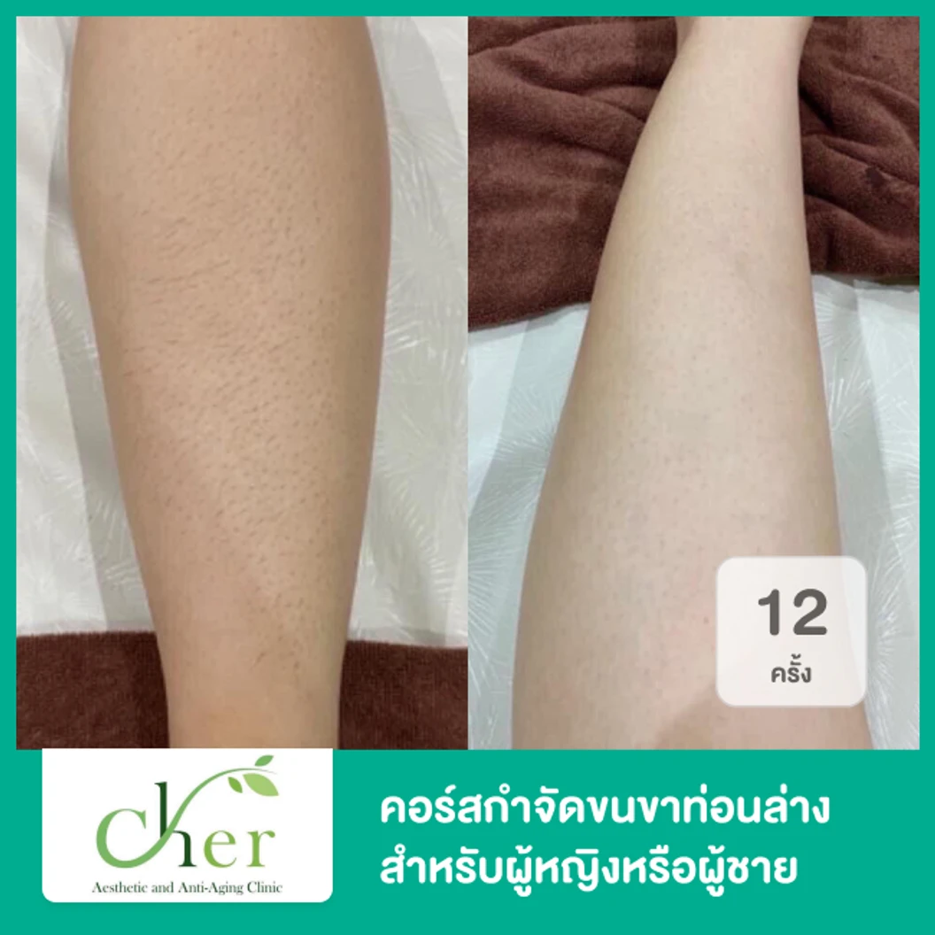 คอร์สกำจัดขนขาท่อนล่าง ด้วย Diode Laser 12 ครั้ง ภายใน 1 ปี สำหรับผู้หญิงหรือผู้ชาย