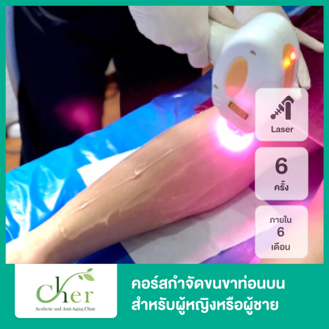 คอร์สกำจัดขนขาท่อนบน ด้วย Diode Laser 6 ครั้ง ภายใน 6 เดือน สำหรับผู้หญิงหรือผู้ชาย