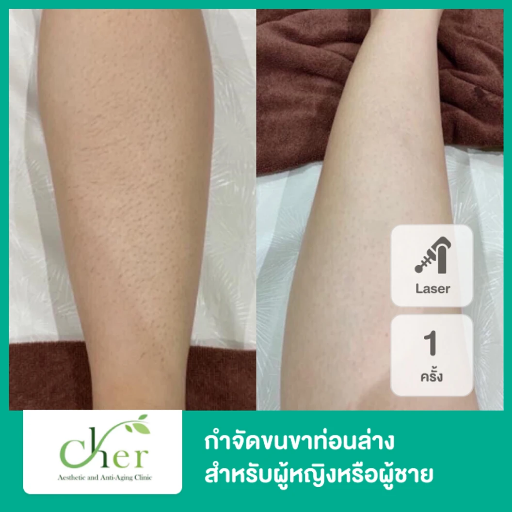 กำจัดขนขาท่อนล่าง ด้วย Diode Laser 1 ครั้ง สำหรับผู้หญิงหรือผู้ชาย