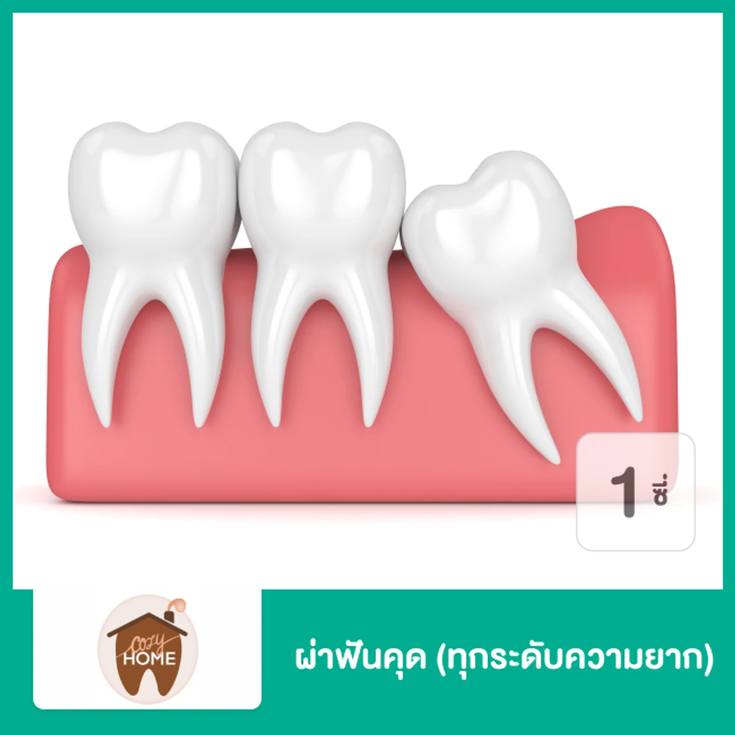 ผ่าฟันคุด 1 ซี่ (ทุกระดับความยาก)