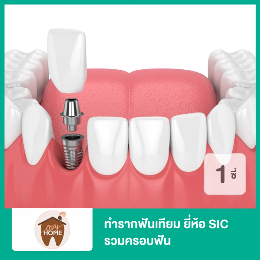 ทำรากฟันเทียม ยี่ห้อ SIC รวมครอบฟัน สำหรับฟัน 1 ซี่