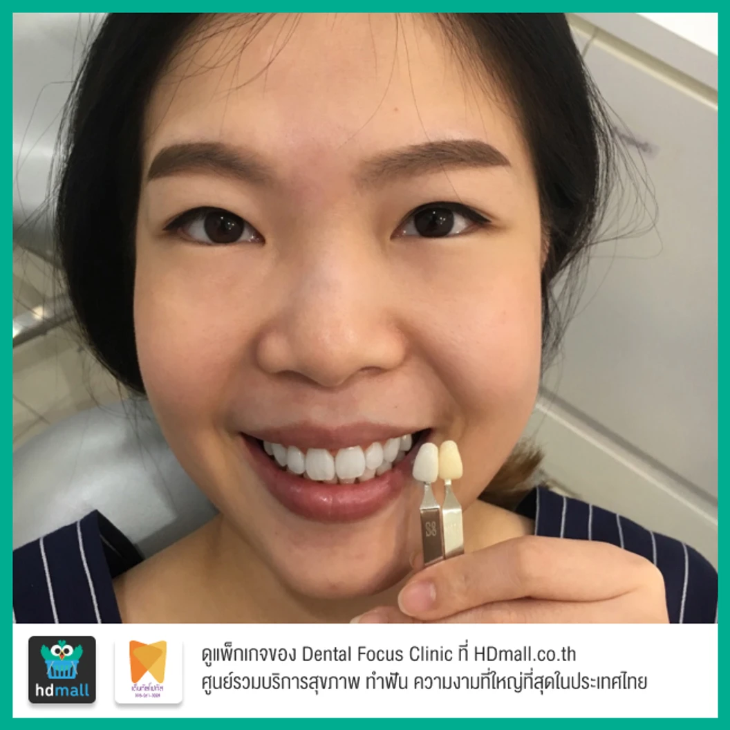 ฟอกสีฟันที่คลินิกด้วยระบบ Cool Light