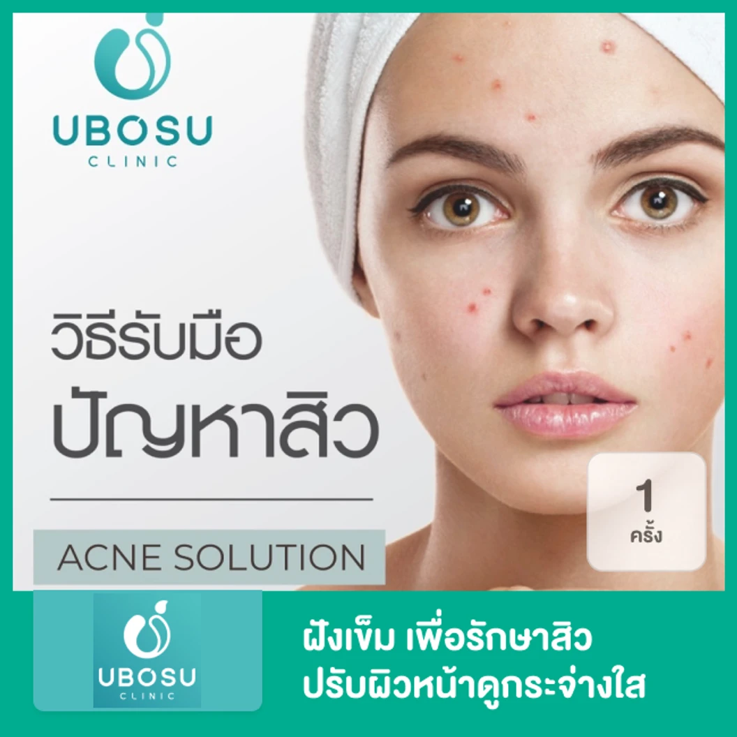 ฝังเข็ม เพื่อรักษาสิว ปรับผิวหน้าดูกระจ่างใส 1 ครั้ง