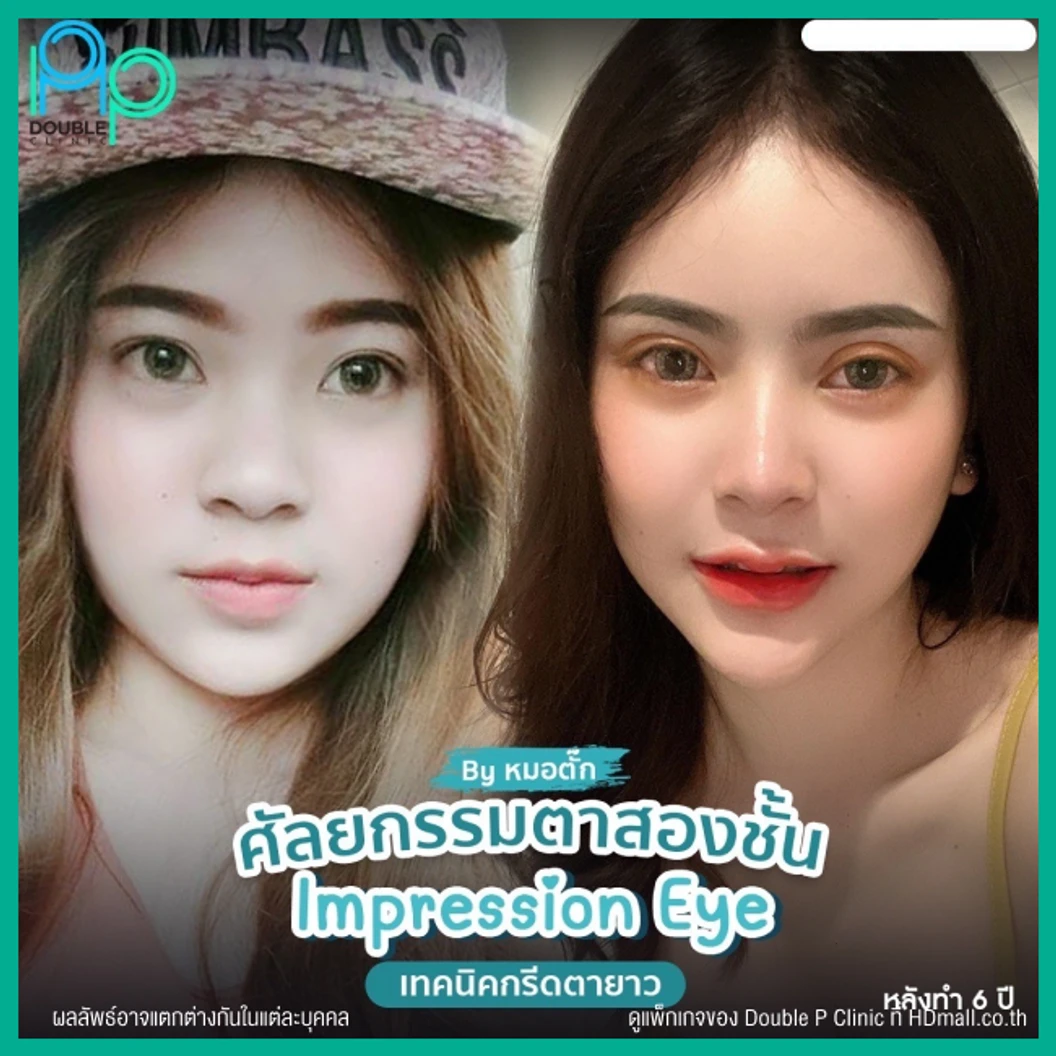 ทำตาสองชั้นแบบกรีดยาว พร้อมตัดหนังตา และไขมันส่วนเกิน เทคนิค Impression Eye สำหรับเคสทำครั้งแรก
