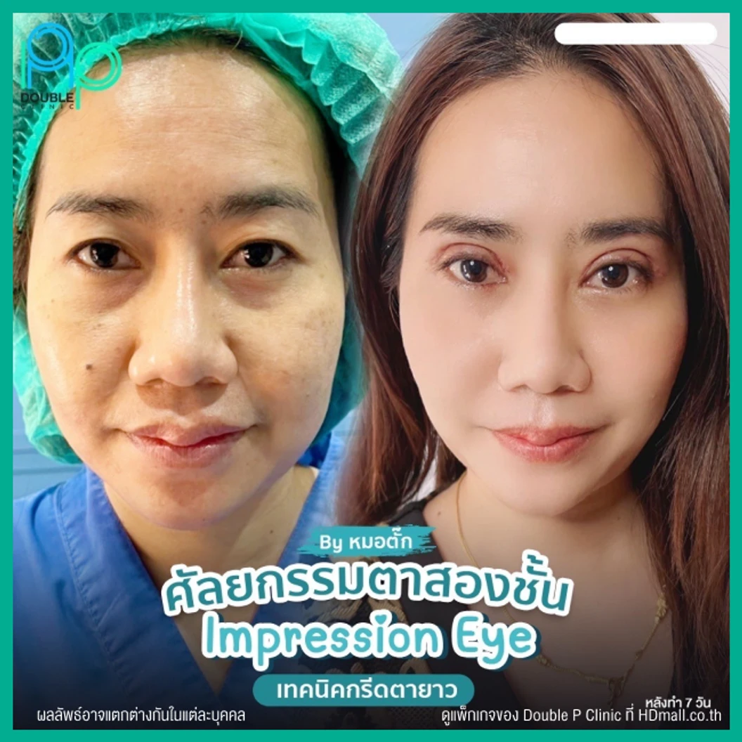 ทำตาสองชั้นแบบกรีดยาว พร้อมตัดหนังตา และไขมันส่วนเกิน เทคนิค Impression Eye สำหรับเคสทำครั้งแรก