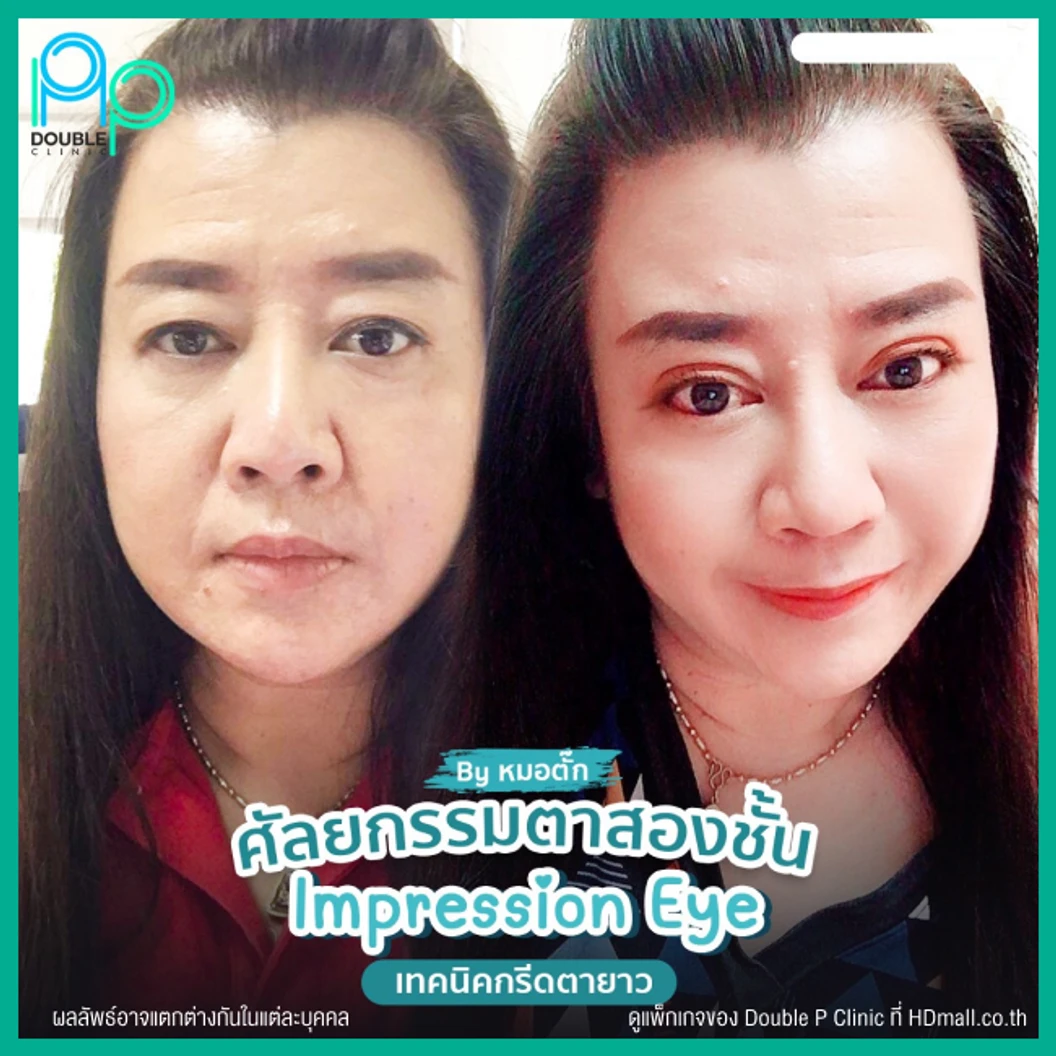 ทำตาสองชั้นแบบกรีดยาว พร้อมตัดหนังตา และไขมันส่วนเกิน เทคนิค Impression Eye สำหรับเคสทำครั้งแรก