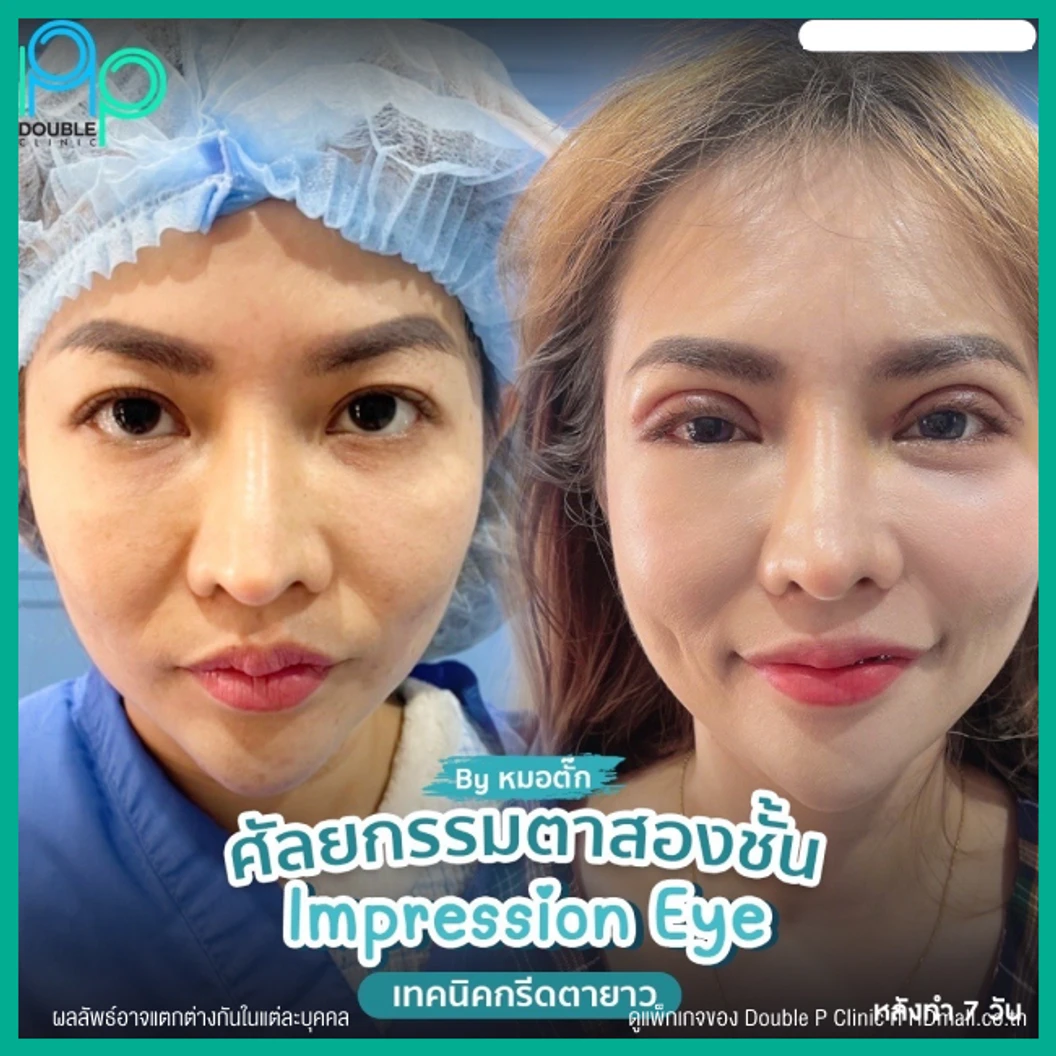 ทำตาสองชั้นแบบกรีดยาว พร้อมตัดหนังตา และไขมันส่วนเกิน เทคนิค Impression Eye สำหรับเคสทำครั้งแรก