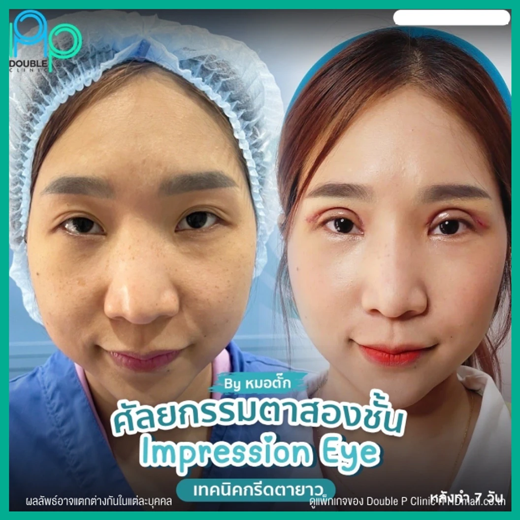 ทำตาสองชั้นแบบกรีดยาว พร้อมตัดหนังตา และไขมันส่วนเกิน เทคนิค Impression Eye สำหรับเคสทำครั้งแรก