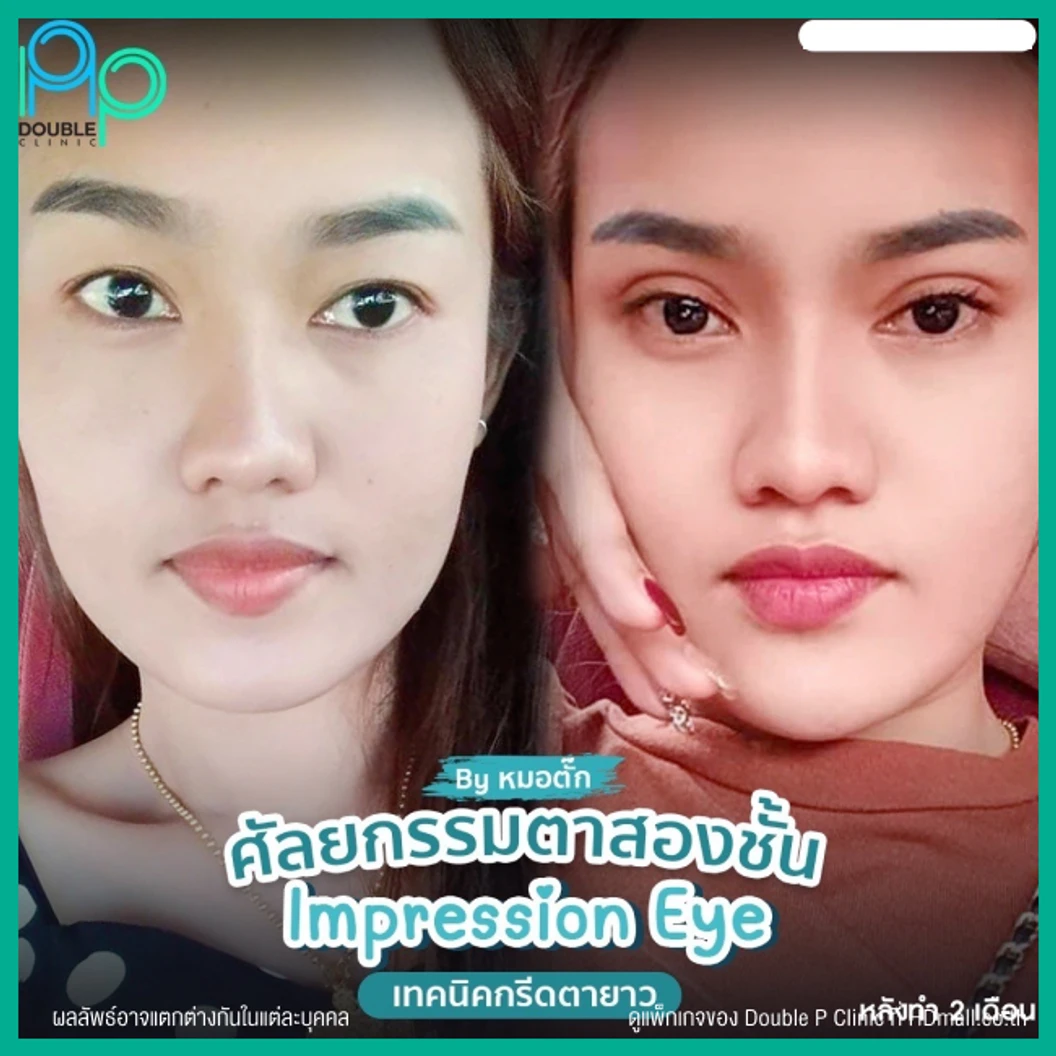 ทำตาสองชั้นแบบกรีดยาว พร้อมตัดหนังตา และไขมันส่วนเกิน เทคนิค Impression Eye สำหรับเคสทำครั้งแรก