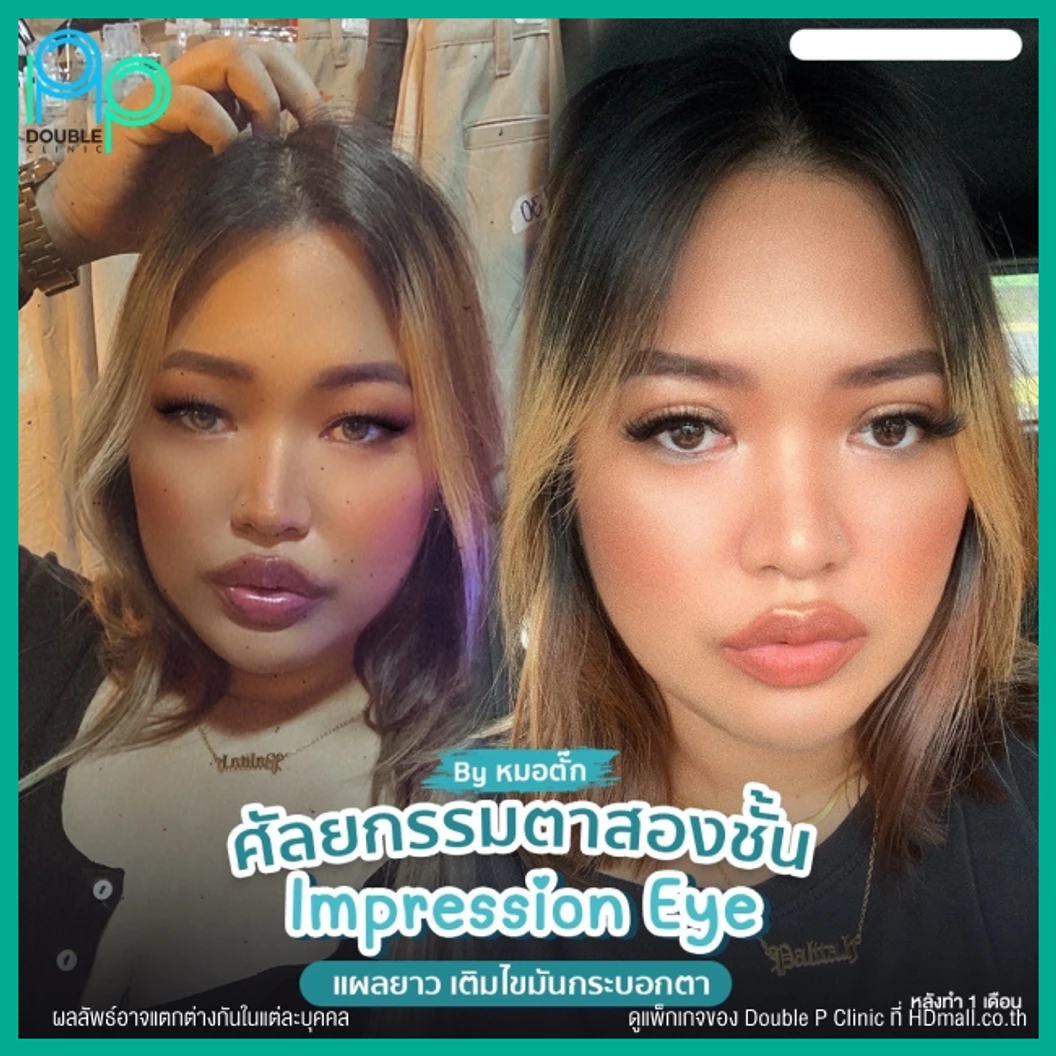 ทำตาสองชั้นแบบกรีดยาว พร้อมตัดหนังตา และไขมันส่วนเกิน เทคนิค Impression Eye สำหรับเคสทำครั้งแรก
