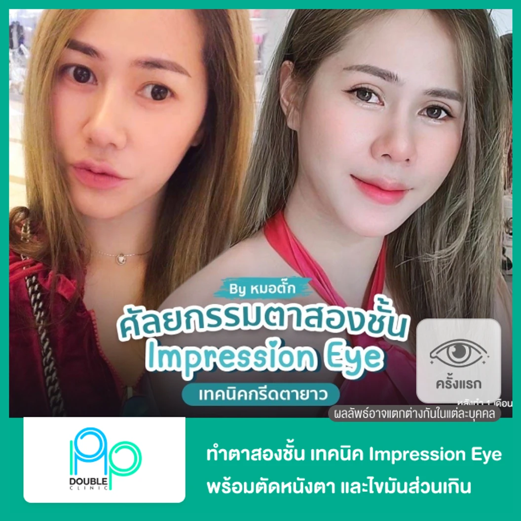 ทำตาสองชั้นแบบกรีดยาว พร้อมตัดหนังตา และไขมันส่วนเกิน เทคนิค Impression Eye สำหรับเคสทำครั้งแรก