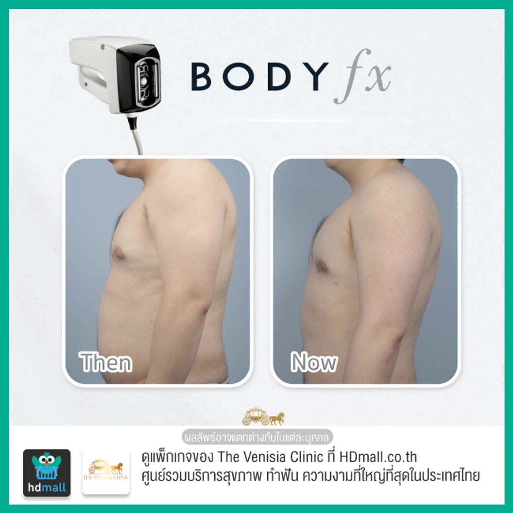 สลายไขมัน กระชับสัดส่วน ด้วยเครื่อง Optimas หัว Body FX บริเวณหน้าท้อง 1 ครั้ง