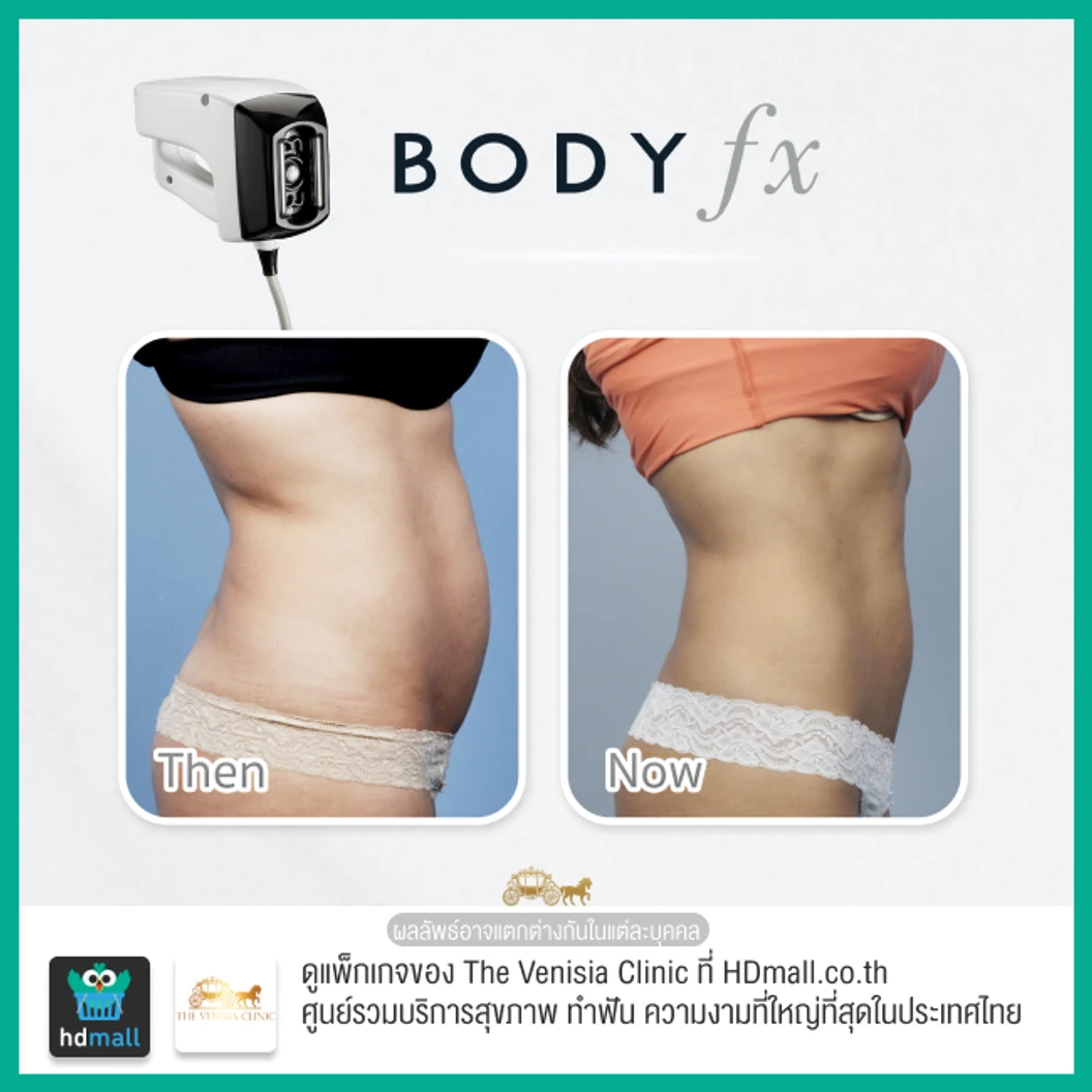 สลายไขมัน กระชับสัดส่วน ด้วยเครื่อง Optimas หัว Body FX บริเวณหน้าท้อง 1 ครั้ง