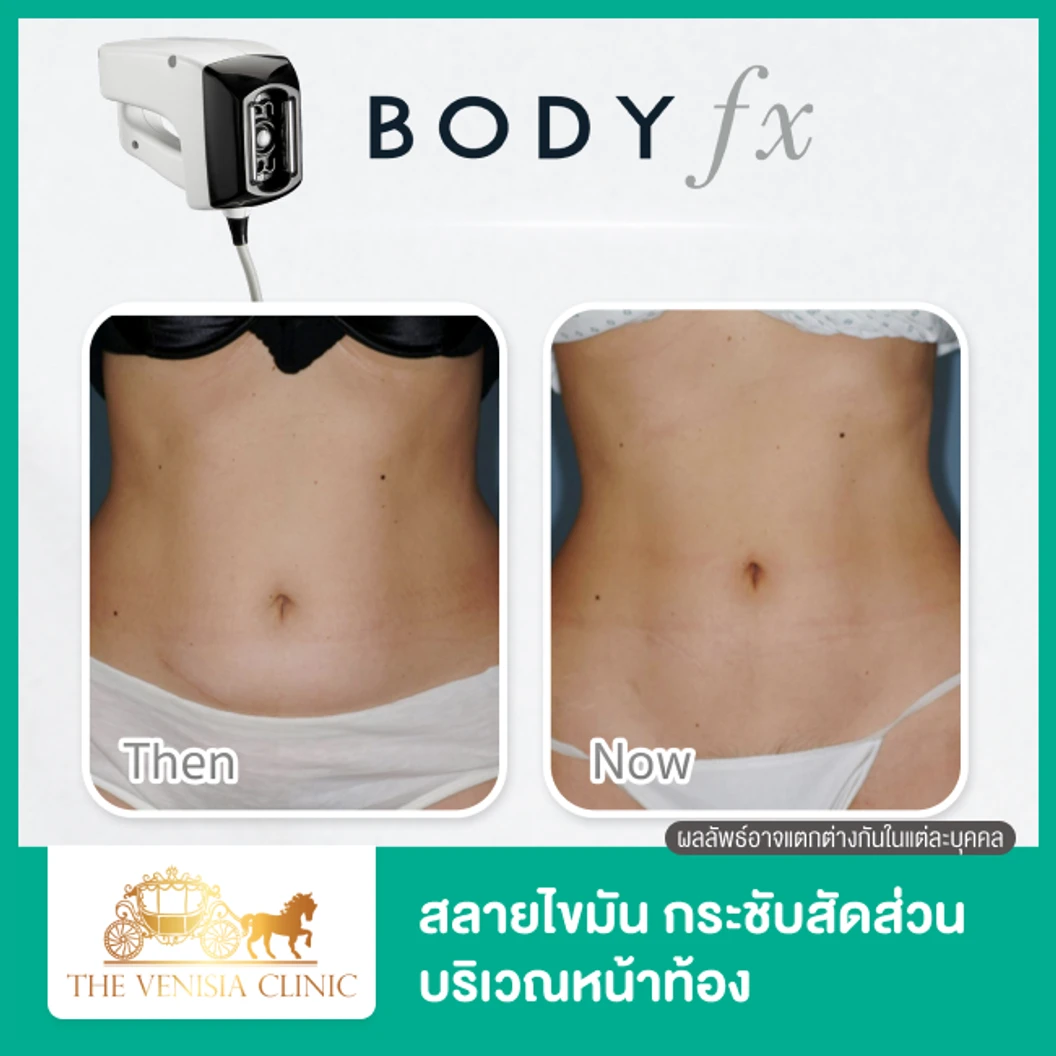 สลายไขมัน กระชับสัดส่วน ด้วยเครื่อง Optimas หัว Body FX บริเวณหน้าท้อง 1 ครั้ง