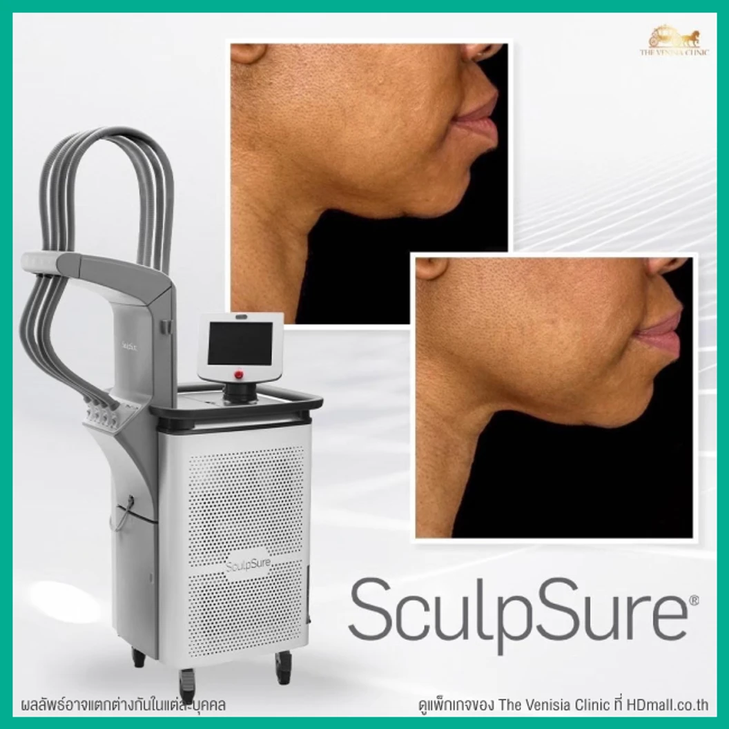 โปรแกรมสลายไขมันบริเวณเหนียง ด้วยเครื่อง SculpSure 1 ครั้ง