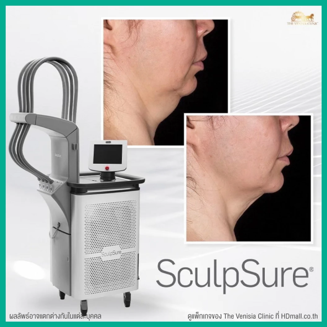 โปรแกรมสลายไขมันบริเวณเหนียง ด้วยเครื่อง SculpSure 1 ครั้ง