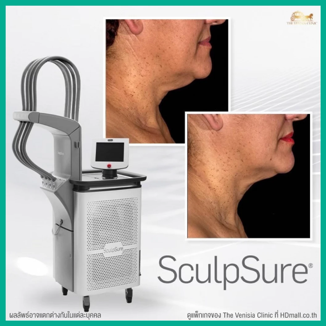 โปรแกรมสลายไขมันบริเวณเหนียง ด้วยเครื่อง SculpSure 1 ครั้ง