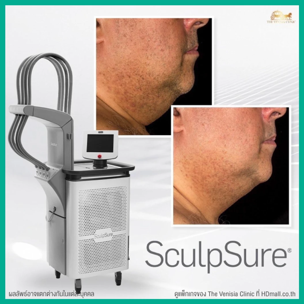 โปรแกรมสลายไขมันบริเวณเหนียง ด้วยเครื่อง SculpSure 1 ครั้ง