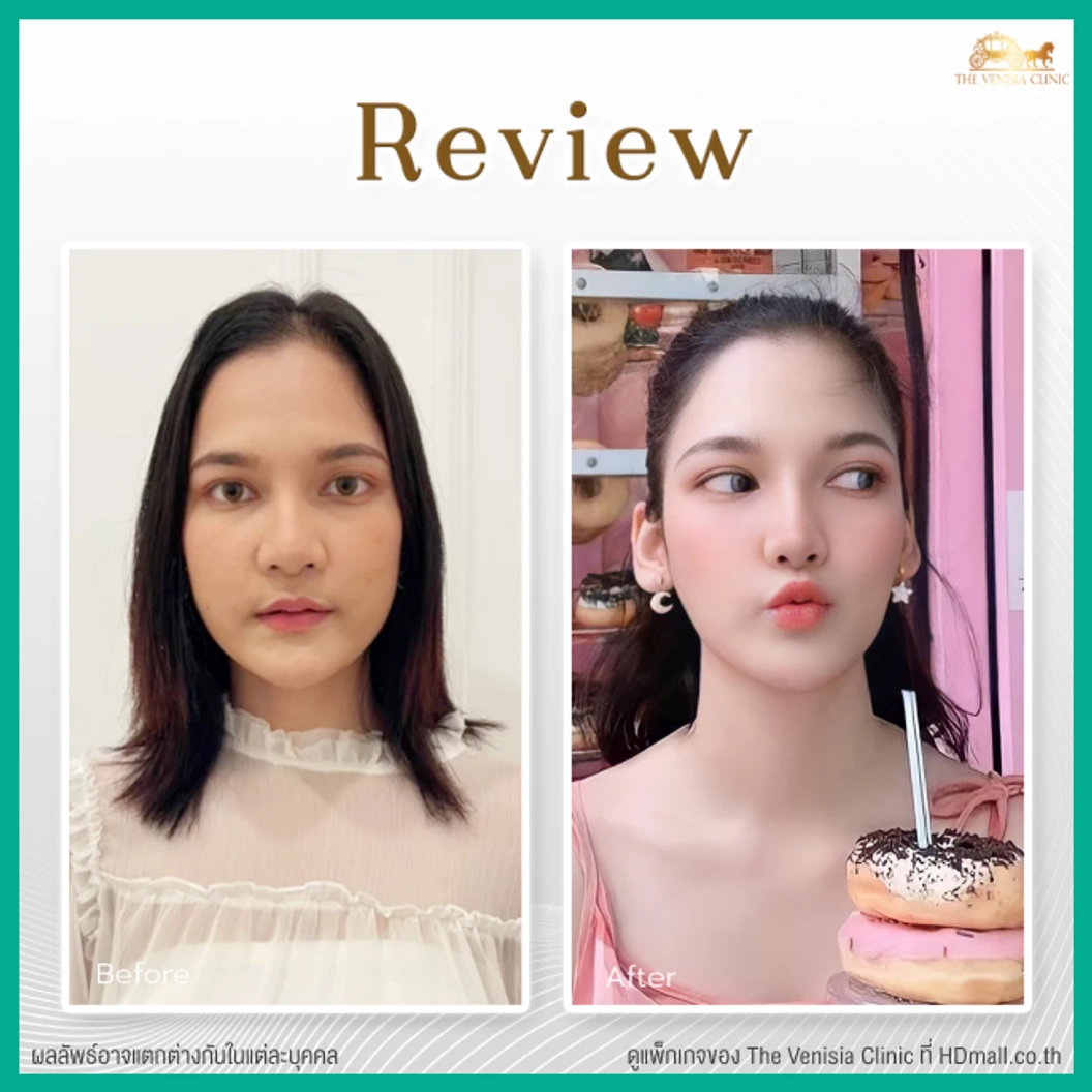 ยกกระชับและสลายไขมัน ด้วย Smart ND Laser บริเวณทั่วใบหน้า 1 ครั้ง ฟรี! ผลึกลดไขมัน 2 ผลึก