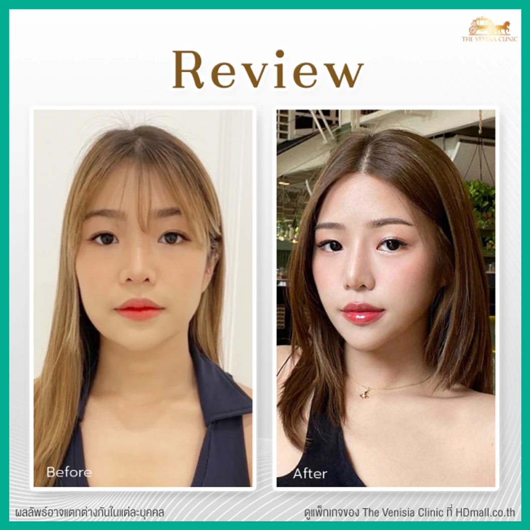 ยกกระชับและสลายไขมัน ด้วย Smart ND Laser บริเวณทั่วใบหน้า 1 ครั้ง ฟรี! ผลึกลดไขมัน 2 ผลึก