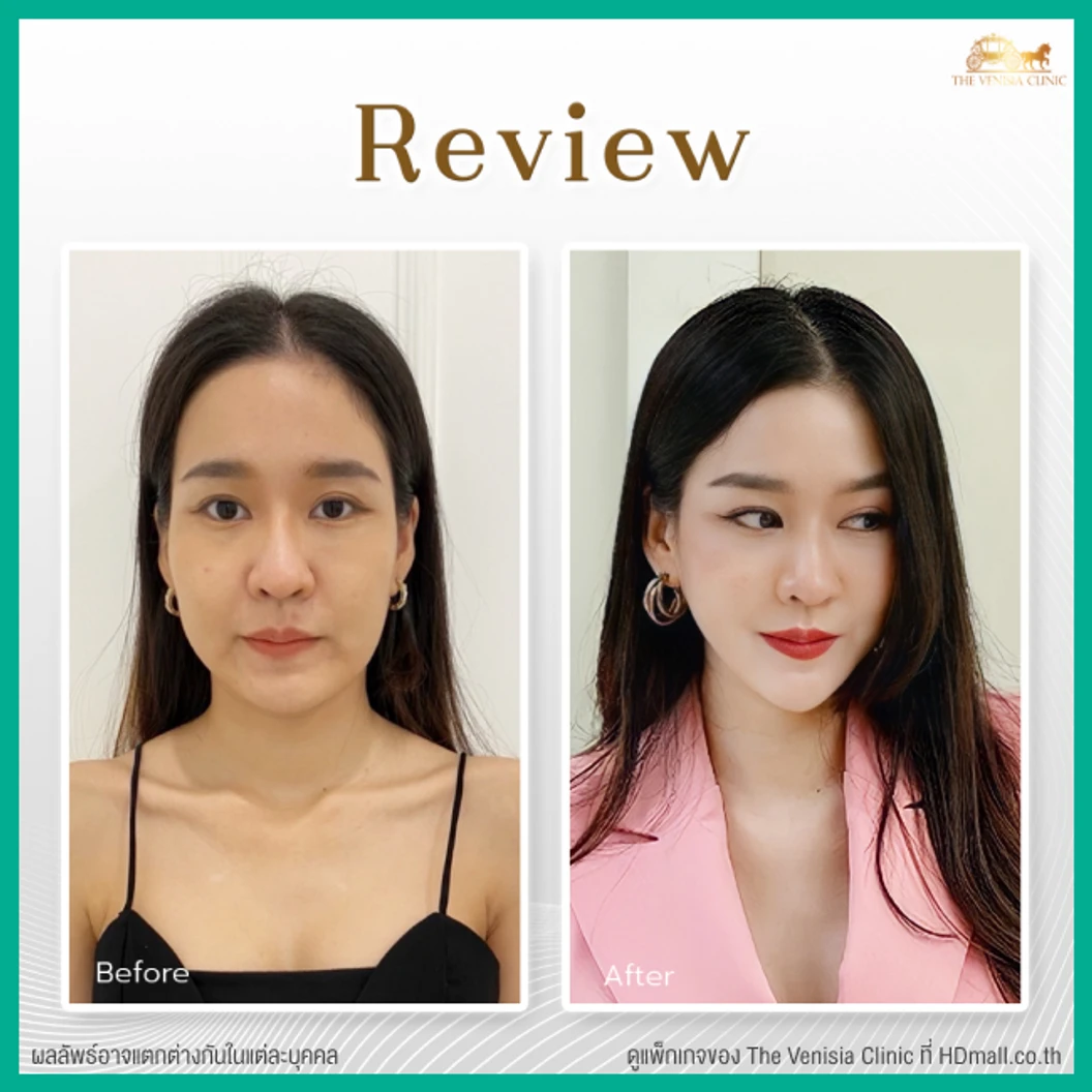 ยกกระชับและสลายไขมัน ด้วย Smart ND Laser บริเวณทั่วใบหน้า 1 ครั้ง ฟรี! ผลึกลดไขมัน 2 ผลึก