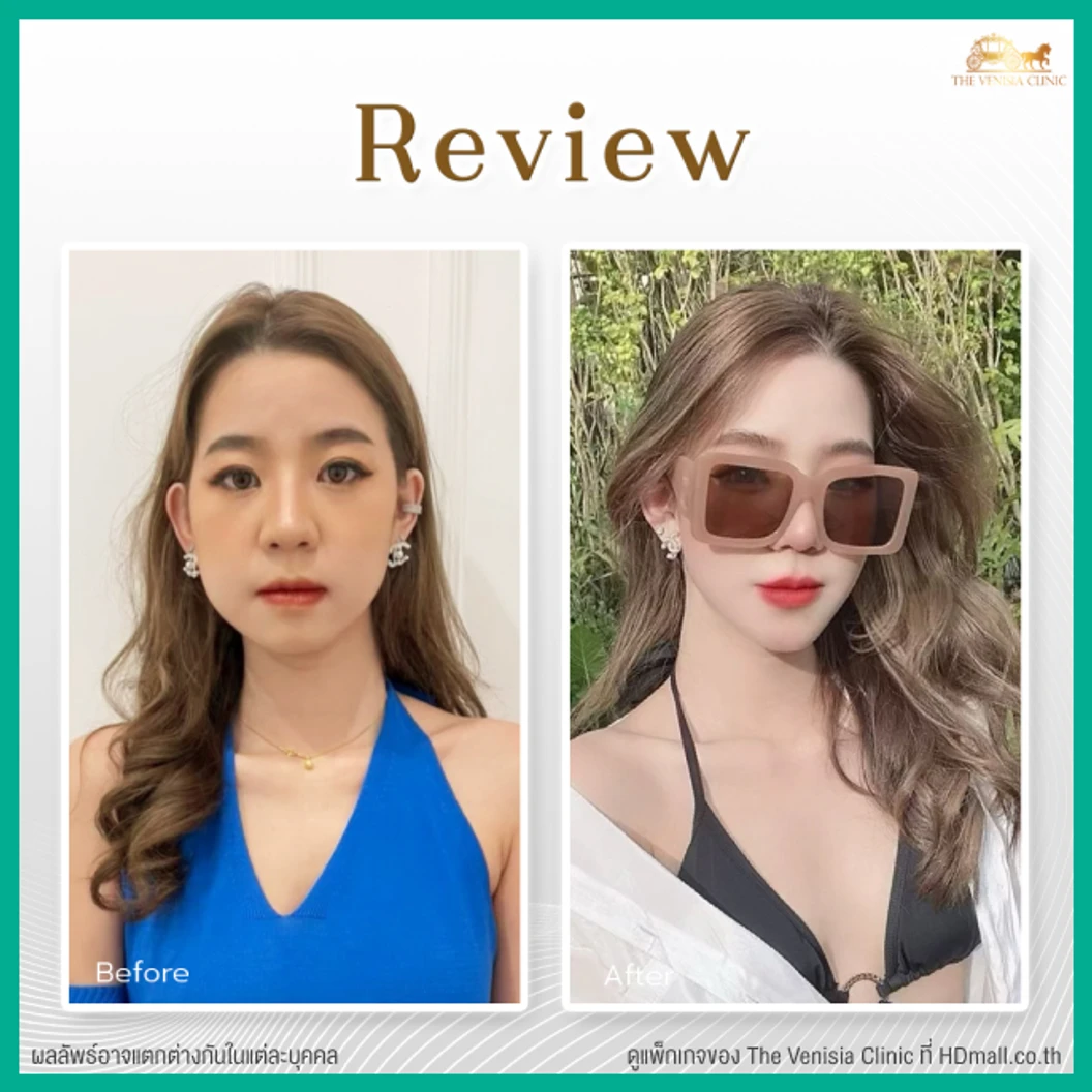 ยกกระชับและสลายไขมัน ด้วย Smart ND Laser บริเวณทั่วใบหน้า 1 ครั้ง ฟรี! ผลึกลดไขมัน 2 ผลึก