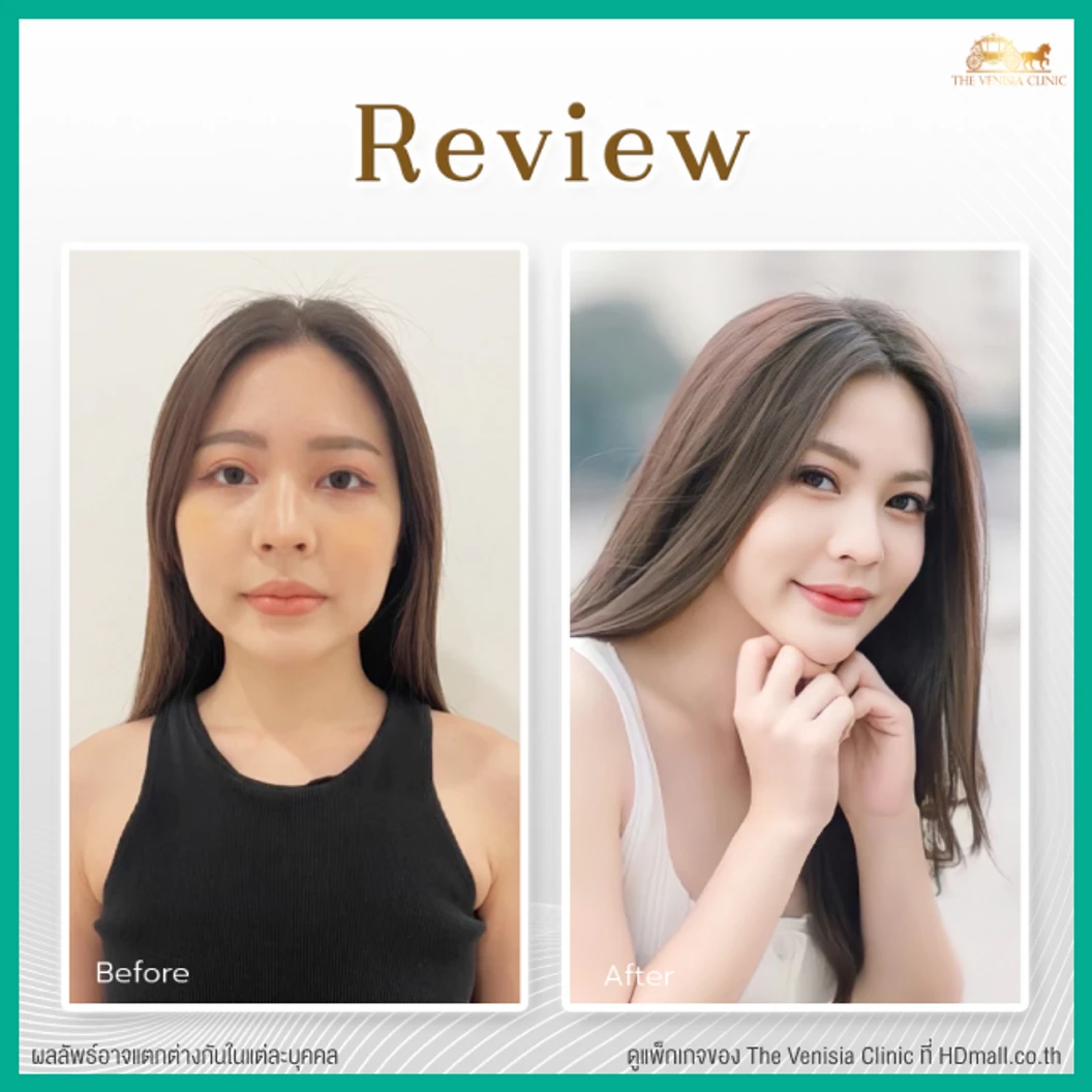 ยกกระชับและสลายไขมัน ด้วย Smart ND Laser บริเวณทั่วใบหน้า 1 ครั้ง ฟรี! ผลึกลดไขมัน 2 ผลึก