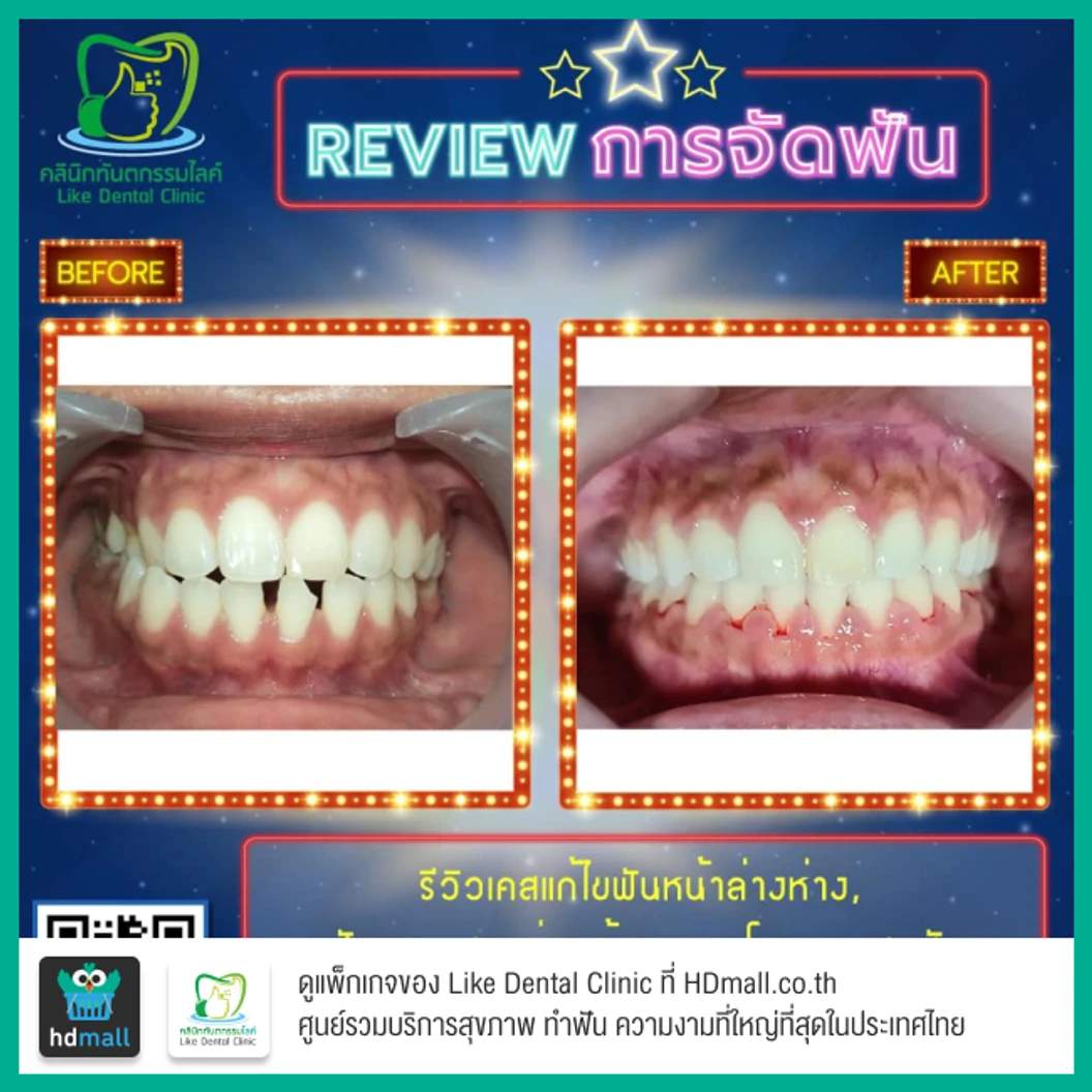 จัดฟัน Damon Q ฟันบนและล่าง