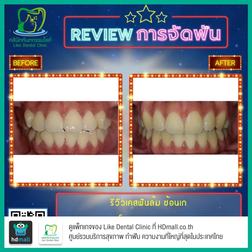 จัดฟัน Damon Q ฟันบนและล่าง