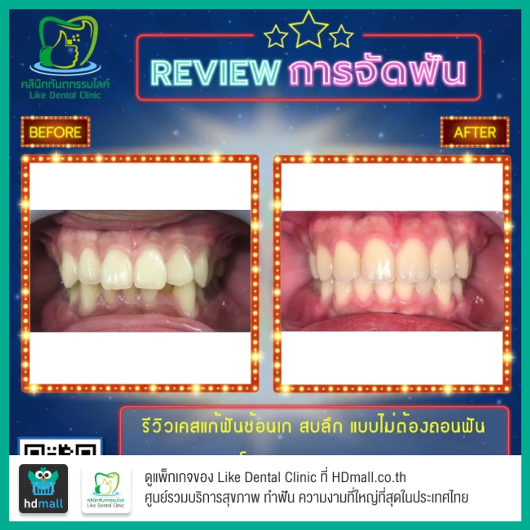 จัดฟัน Damon Q ฟันบนและล่าง