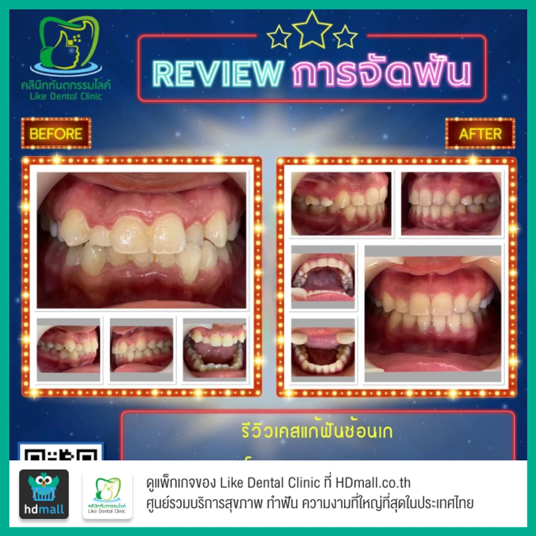 จัดฟัน Damon Q ฟันบนและล่าง