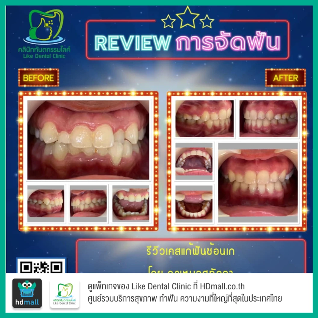 จัดฟัน Damon Q ฟันบนและล่าง